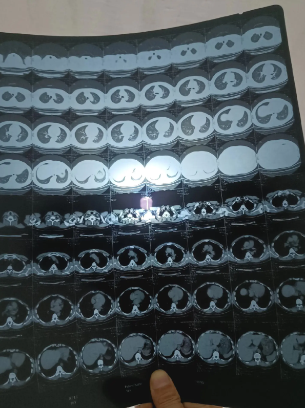 医院CT检查胶片