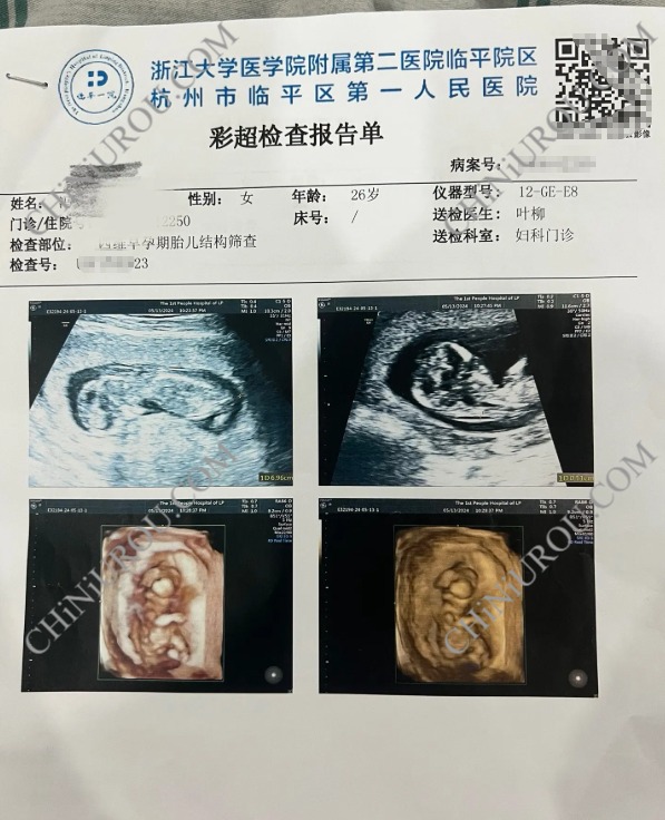 杭州临平医院B超报告单